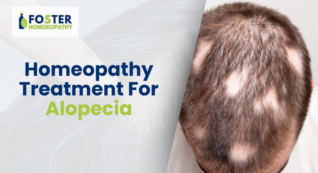 Homeopathy treatment for alopecia - natural remedy for hair loss