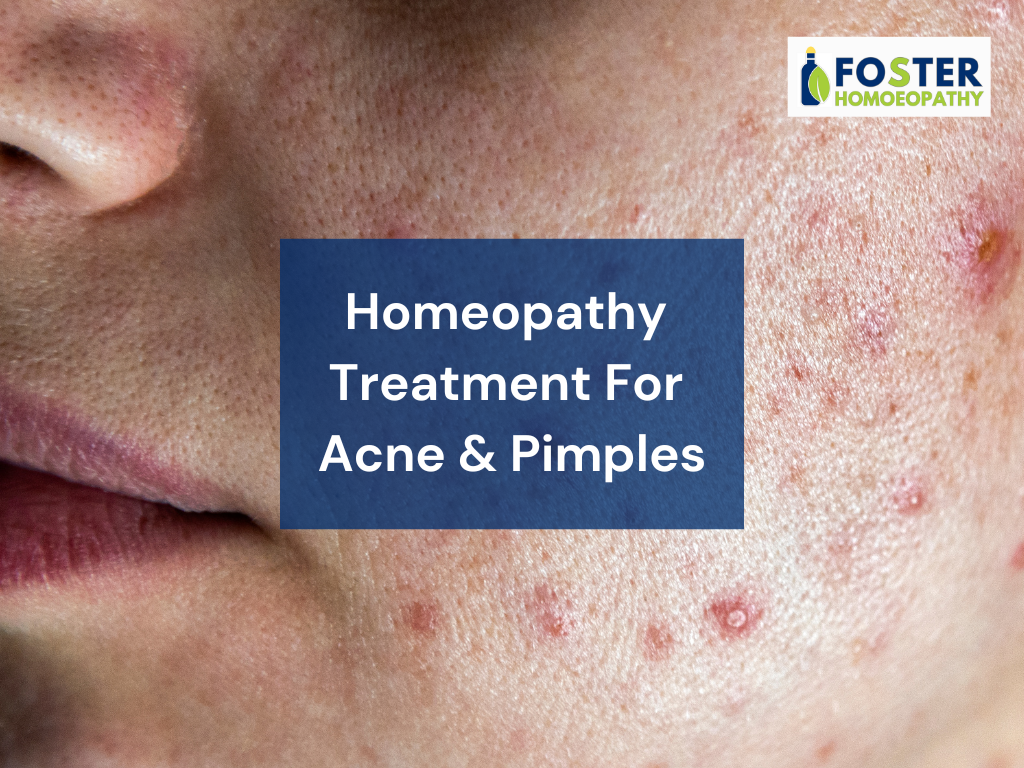 Homeopathy treatment for Acne